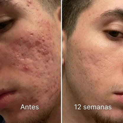 Stick Corrector de Cicatrices de Acné™